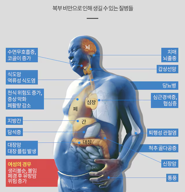 복부비만으로 인해 생길 수 있는 질병들